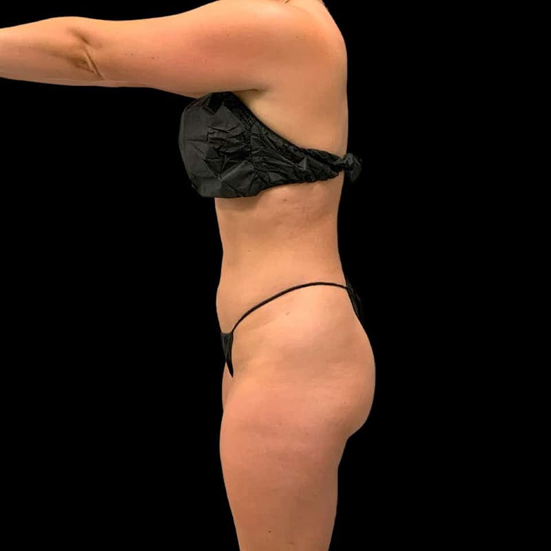 High Definition Lipo Before & After Gallery - Patient 197981 - Image 6