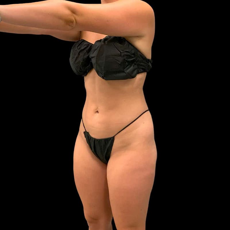 High Definition Lipo Before & After Gallery - Patient 197981 - Image 8