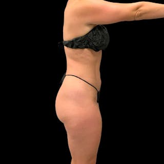 High Definition Lipo Before & After Gallery - Patient 197981 - Image 10