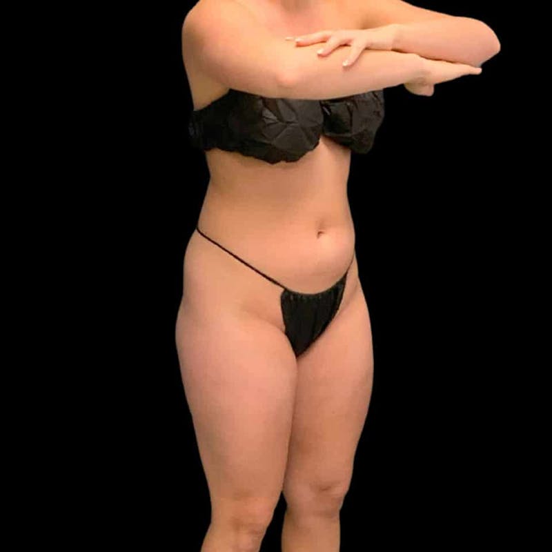 High Definition Lipo Before & After Gallery - Patient 197981 - Image 11