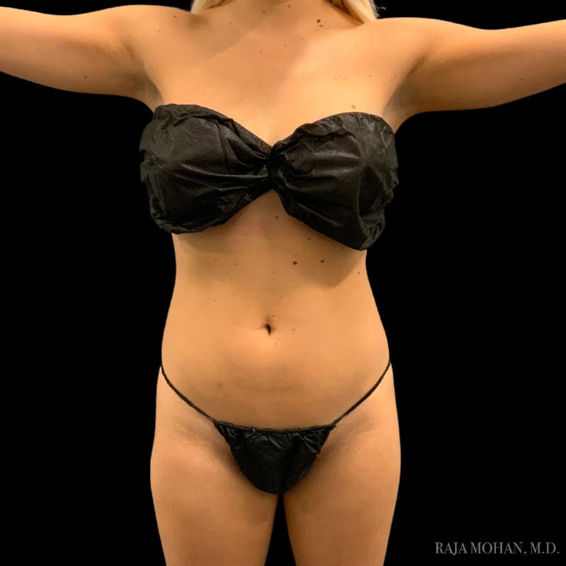 High Definition Lipo Before & After Gallery - Patient 186392 - Image 1