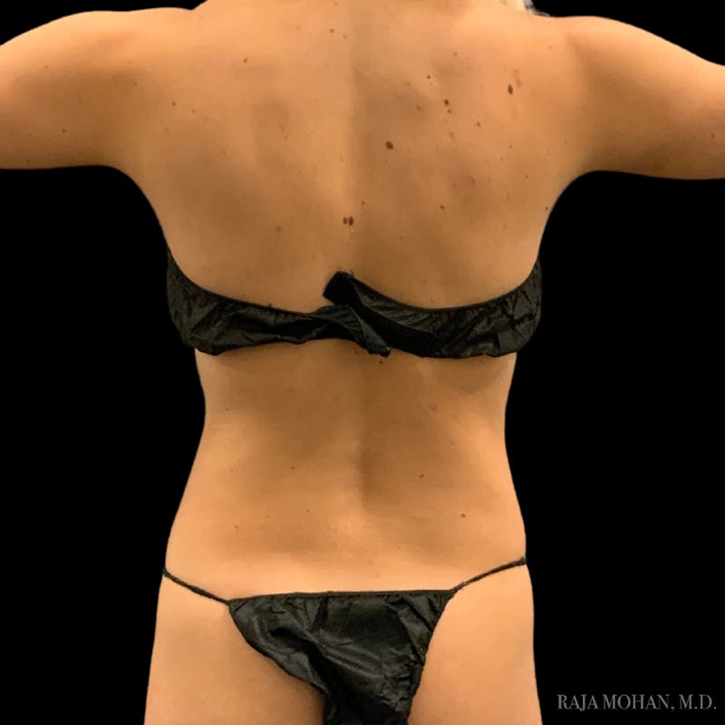 High Definition Lipo Before & After Gallery - Patient 186392 - Image 3