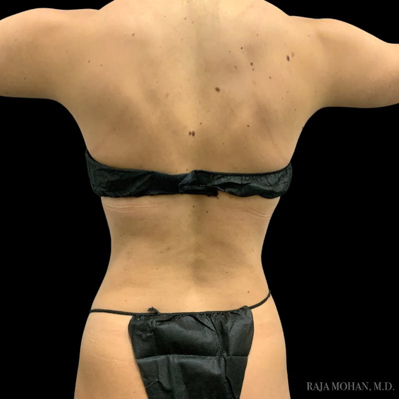 High Definition Lipo Before & After Gallery - Patient 186392 - Image 4