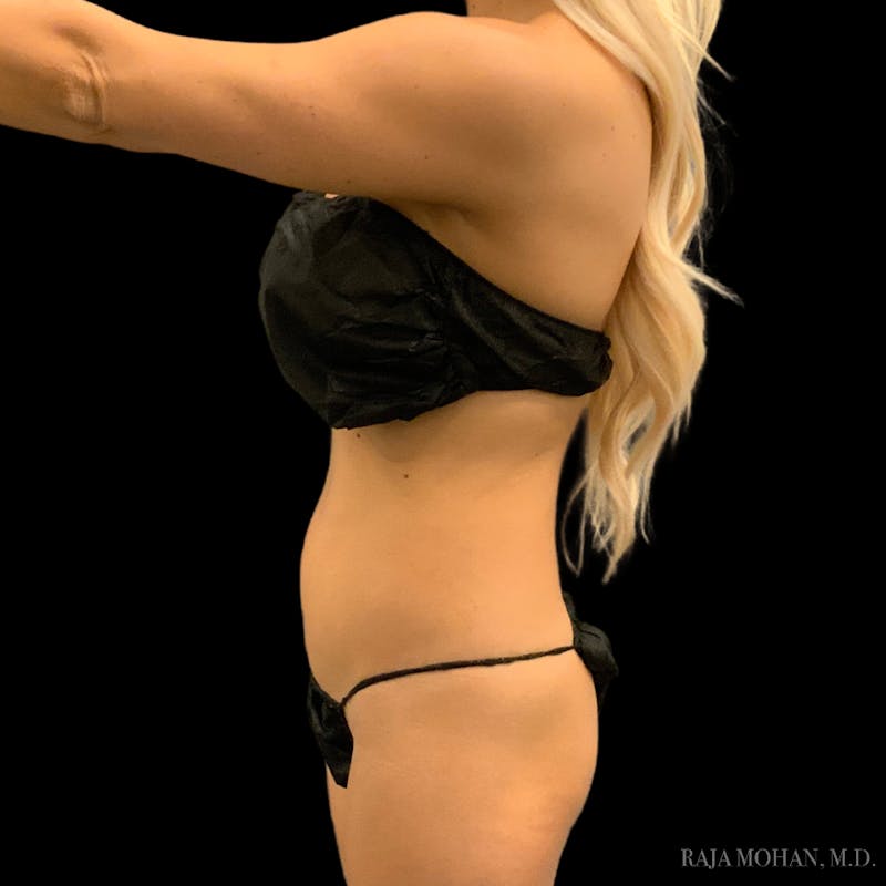 High Definition Lipo Before & After Gallery - Patient 186392 - Image 5