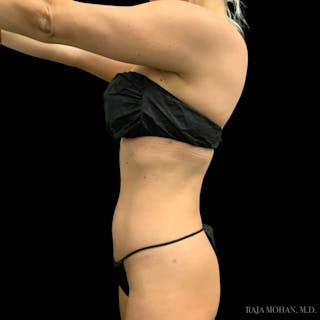 High Definition Lipo Before & After Gallery - Patient 186392 - Image 6