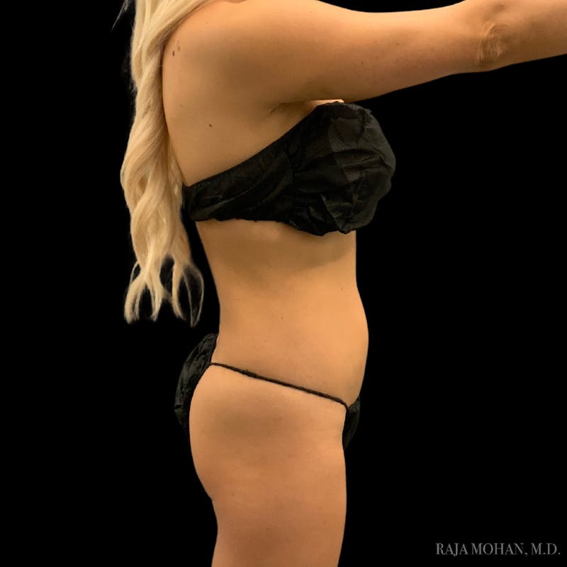 High Definition Lipo Before & After Gallery - Patient 186392 - Image 9