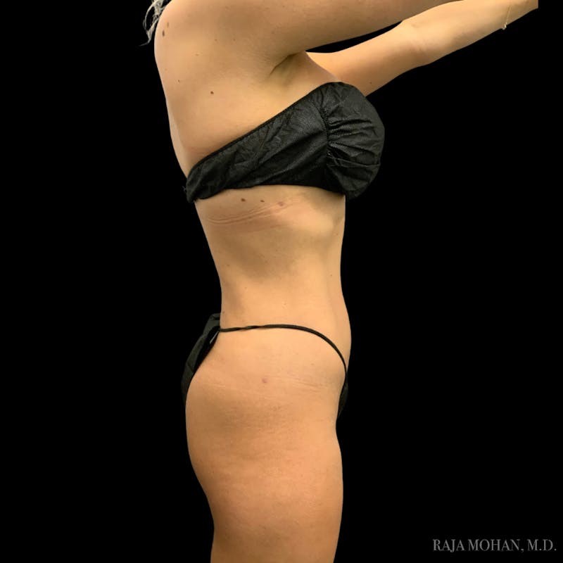 High Definition Lipo Before & After Gallery - Patient 186392 - Image 10