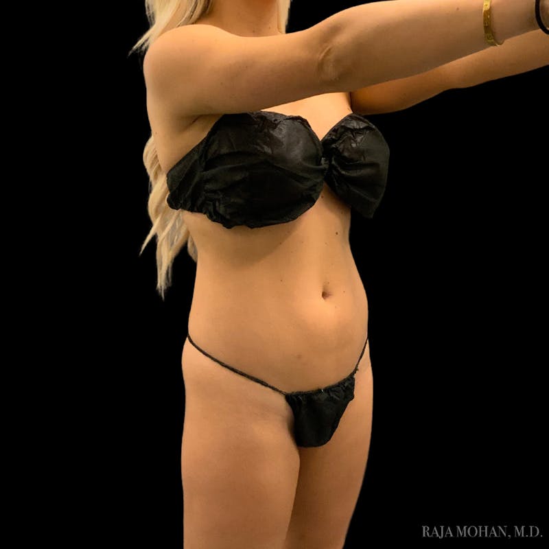High Definition Lipo Before & After Gallery - Patient 186392 - Image 11