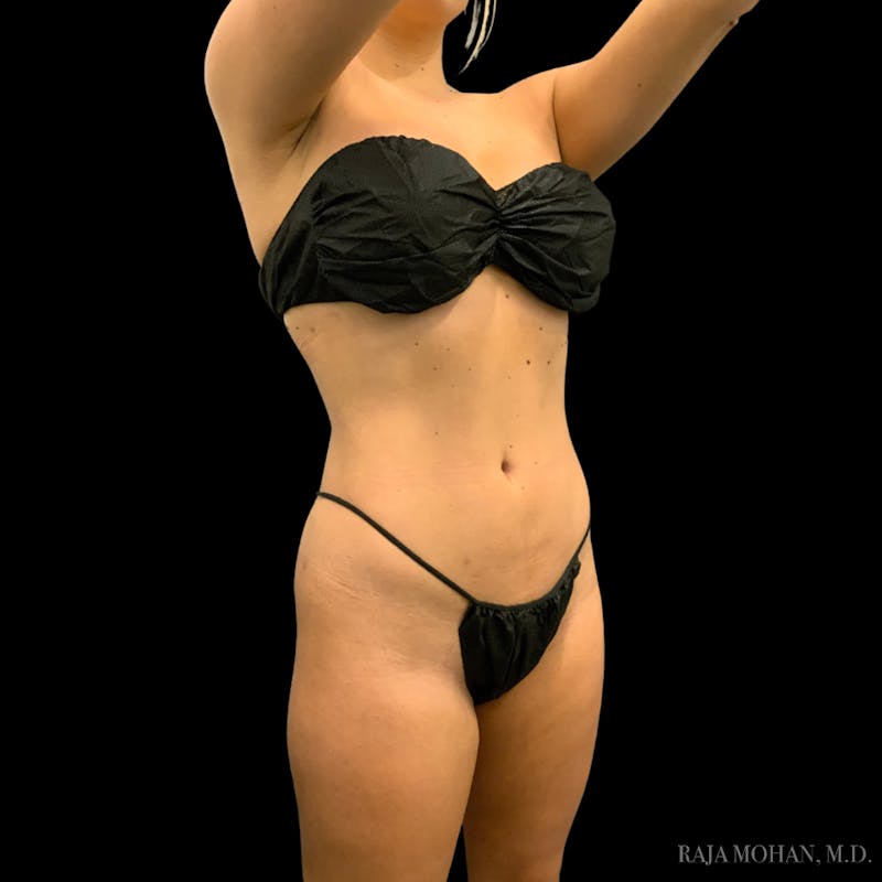 High Definition Lipo Before & After Gallery - Patient 186392 - Image 12