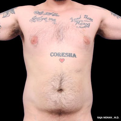 High Definition Lipo Before & After Gallery - Patient 170603 - Image 1