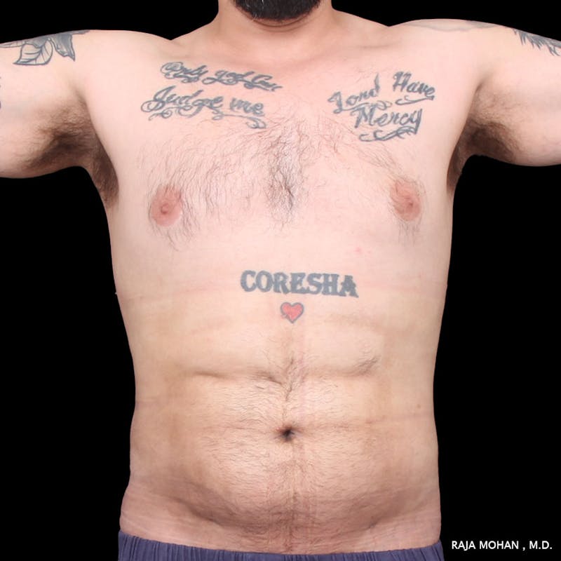 High Definition Lipo Before & After Gallery - Patient 170603 - Image 2