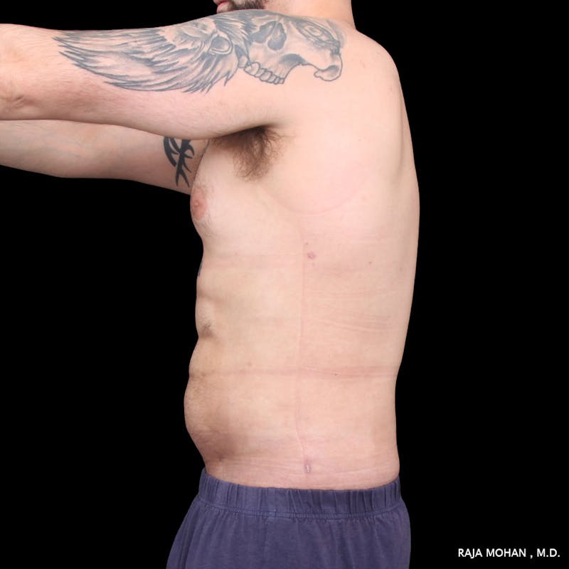 High Definition Lipo Before & After Gallery - Patient 170603 - Image 4