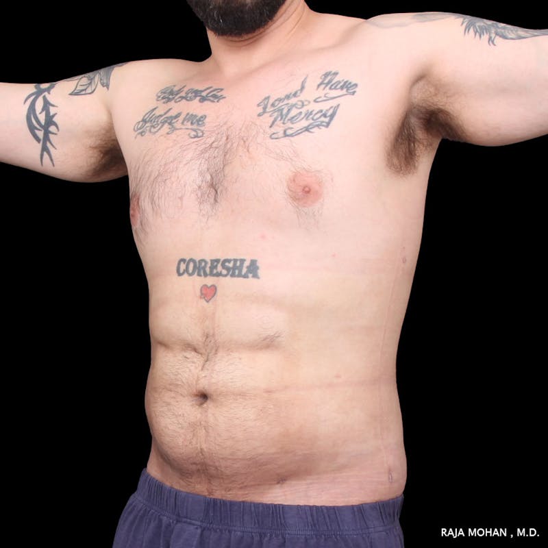 High Definition Lipo Before & After Gallery - Patient 170603 - Image 6