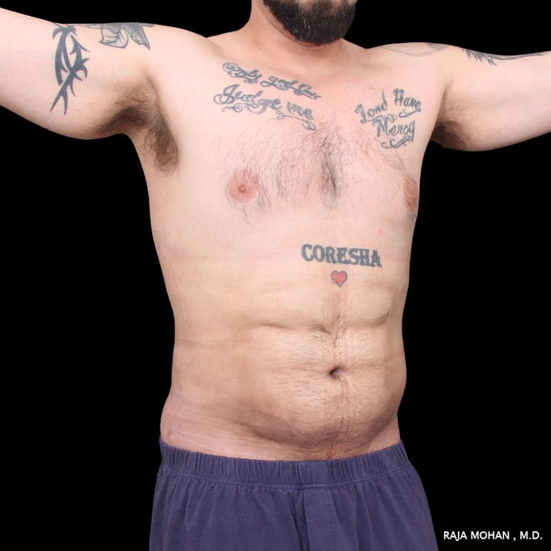 High Definition Lipo Before & After Gallery - Patient 170603 - Image 8