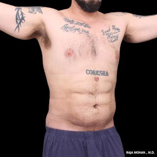 High Definition Lipo Before & After Gallery - Patient 170603 - Image 8