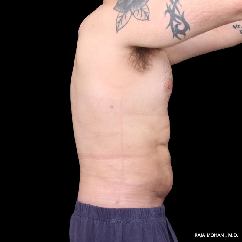 High Definition Lipo Before & After Gallery - Patient 170603 - Image 10