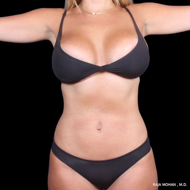 High Definition Lipo Before & After Gallery - Patient 325348 - Image 2