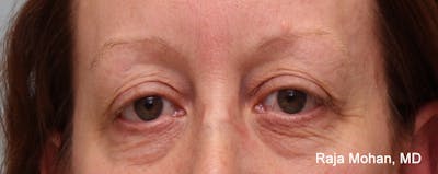 Blepharoplasty Before & After Gallery - Patient 426748 - Image 1