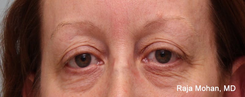 Blepharoplasty Before & After Gallery - Patient 426748 - Image 1