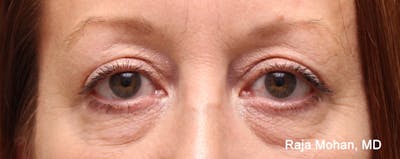 Blepharoplasty Before & After Gallery - Patient 426748 - Image 2