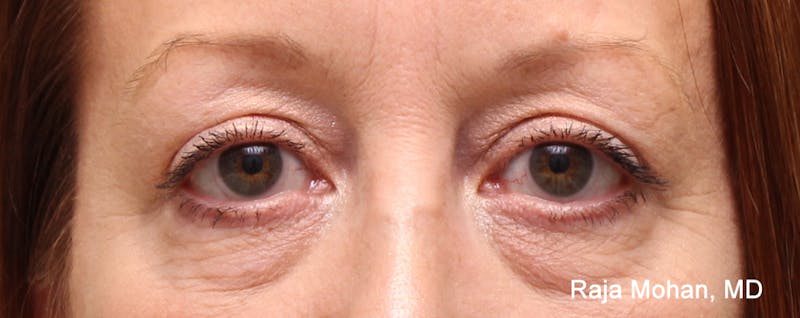 Blepharoplasty Before & After Gallery - Patient 426748 - Image 2