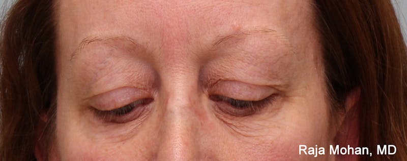 Blepharoplasty Before & After Gallery - Patient 426748 - Image 3