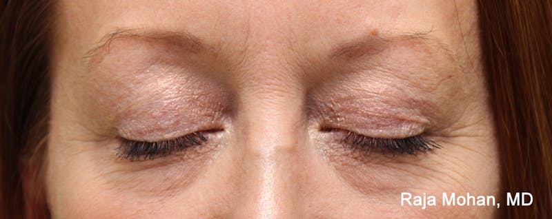 Blepharoplasty Before & After Gallery - Patient 426748 - Image 4