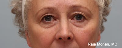 Blepharoplasty Before & After Gallery - Patient 267789 - Image 1