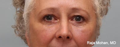 Blepharoplasty Before & After Gallery - Patient 267789 - Image 2
