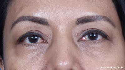 Blepharoplasty Before & After Gallery - Patient 259504 - Image 1