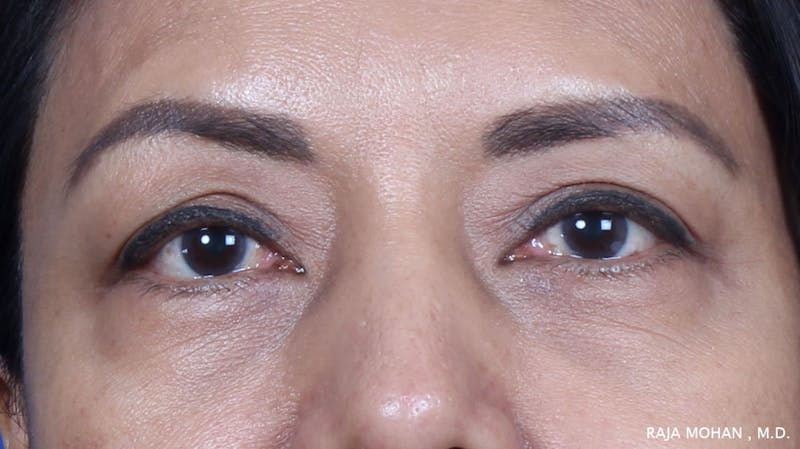 Blepharoplasty Before & After Gallery - Patient 259504 - Image 1