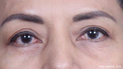Blepharoplasty Before & After Gallery - Patient 259504 - Image 2