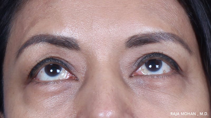 Blepharoplasty Before & After Gallery - Patient 259504 - Image 3