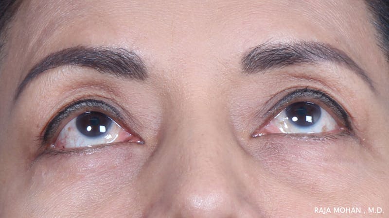 Blepharoplasty Before & After Gallery - Patient 259504 - Image 4