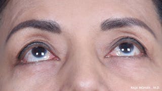 Blepharoplasty Before & After Gallery - Patient 259504 - Image 4