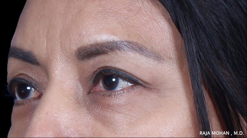 Blepharoplasty Before & After Gallery - Patient 259504 - Image 5