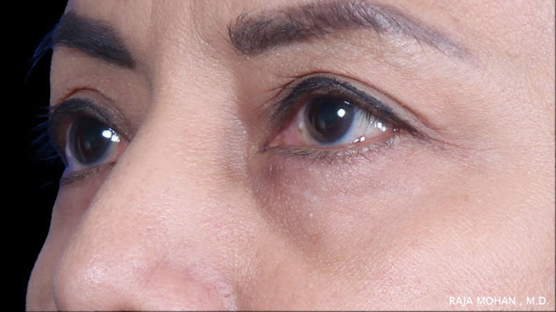 Blepharoplasty Before & After Gallery - Patient 259504 - Image 6