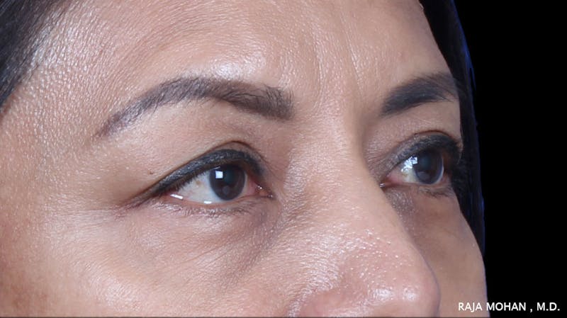 Blepharoplasty Before & After Gallery - Patient 259504 - Image 7