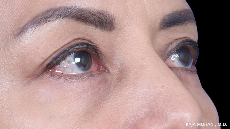 Blepharoplasty Before & After Gallery - Patient 259504 - Image 8