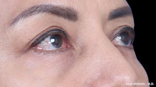 Blepharoplasty Before & After Gallery - Patient 259504 - Image 8