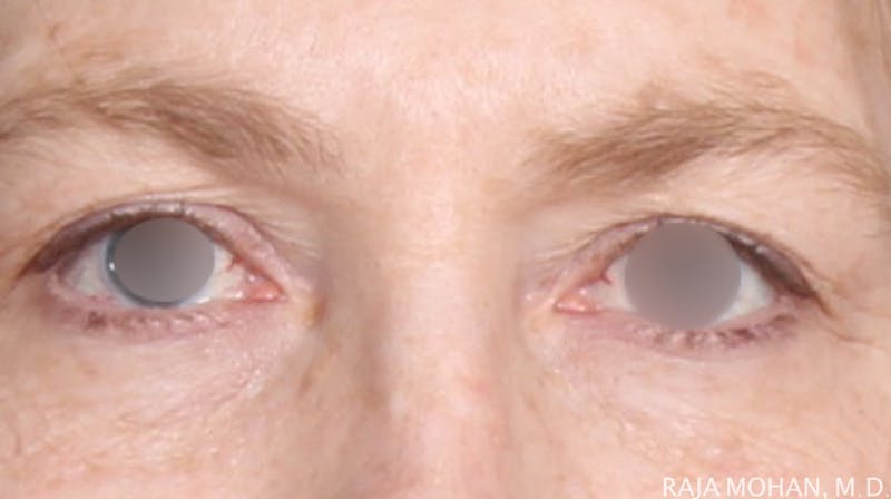 Blepharoplasty Before & After Gallery - Patient 279895 - Image 1