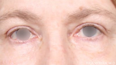 Blepharoplasty Before & After Gallery - Patient 279895 - Image 2