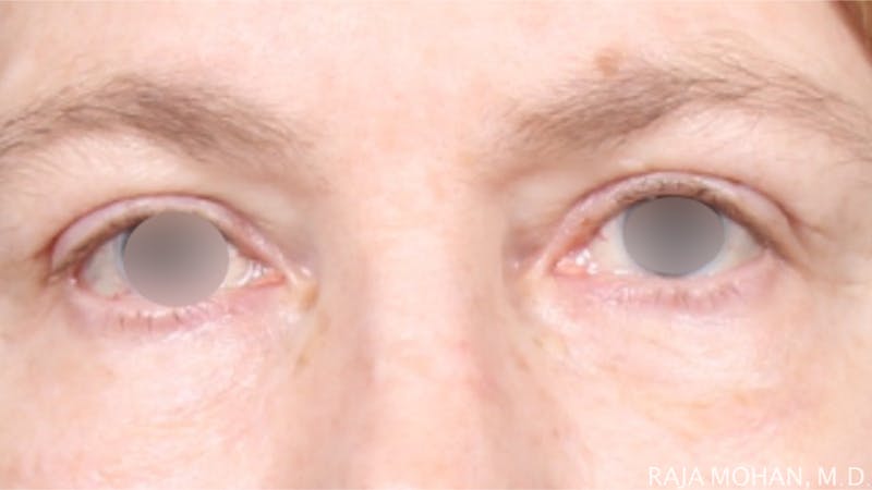 Blepharoplasty Before & After Gallery - Patient 279895 - Image 2