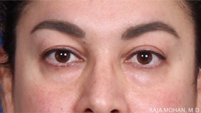 Blepharoplasty Before & After Gallery - Patient 645364 - Image 1