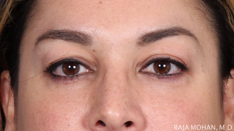 Blepharoplasty Before & After Gallery - Patient 645364 - Image 2
