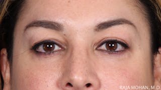 Blepharoplasty Before & After Gallery - Patient 645364 - Image 2