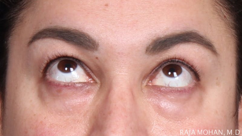 Blepharoplasty Before & After Gallery - Patient 645364 - Image 3