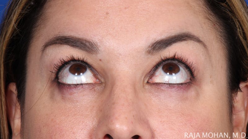 Blepharoplasty Before & After Gallery - Patient 645364 - Image 4