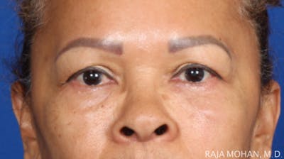 Blepharoplasty Before & After Gallery - Patient 210732 - Image 1