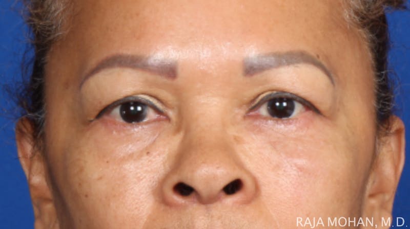Blepharoplasty Before & After Gallery - Patient 210732 - Image 1
